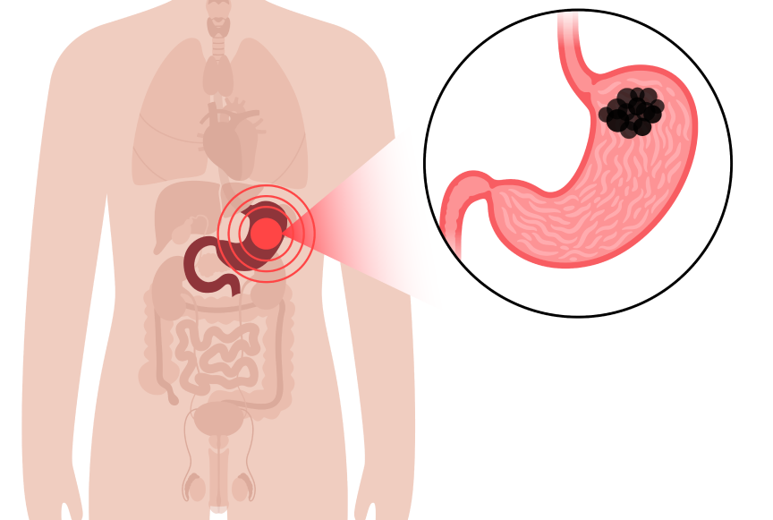 stomach-cancer-symptoms-causes-stages-expert-insights